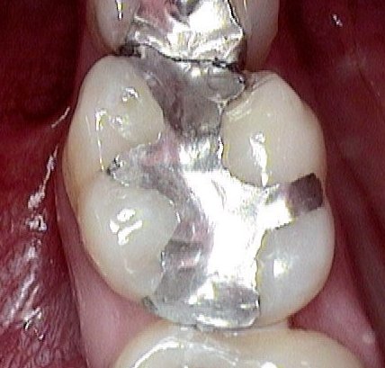 Provisorische füllung wurzelbehandlung Zahnschmerzen nach