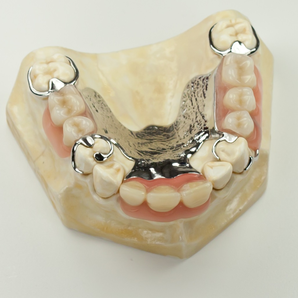 Ohne gaumenplatte zahnersatz Zahnprothese: Teilprothese,